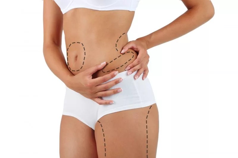 liposuction-lucknow