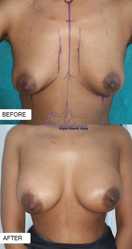 breast augmentation in lucknow