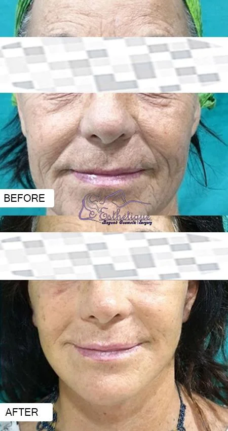 facelift surgery in lucknow