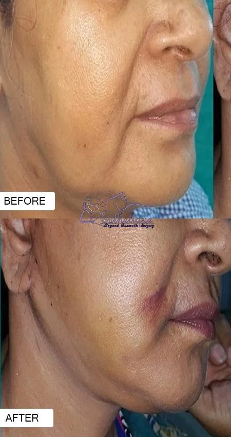 facelift surgery in lucknow