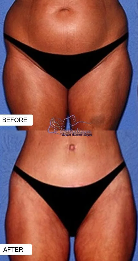 liposuction in lucknow