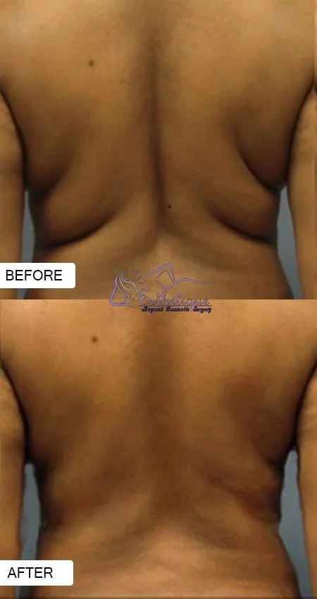 liposuction in lucknow