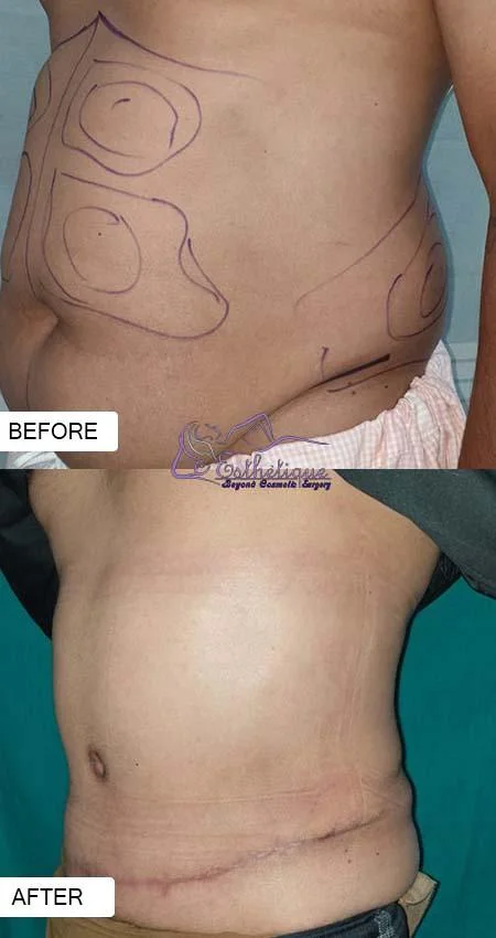 tummy tuck in lucknow