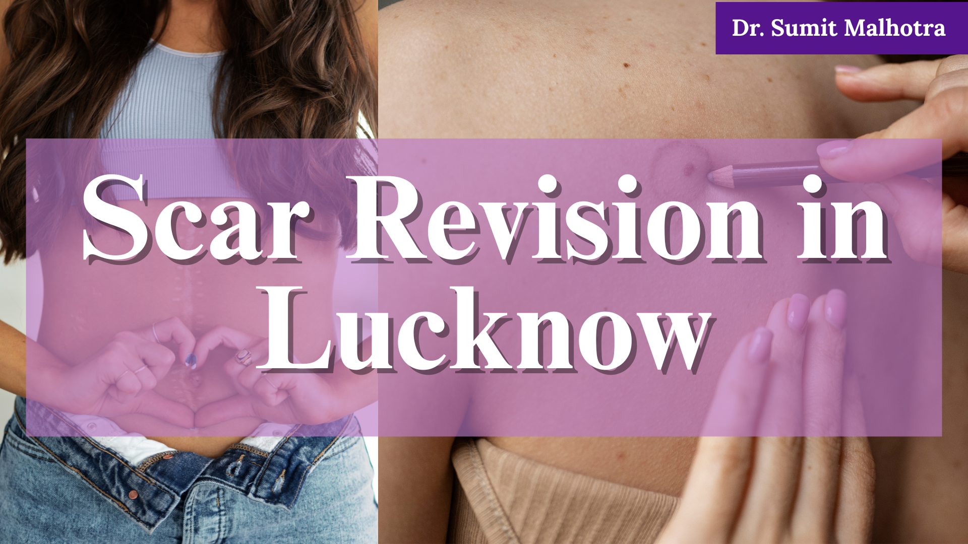 Scar Revision Treatment in Surgery
